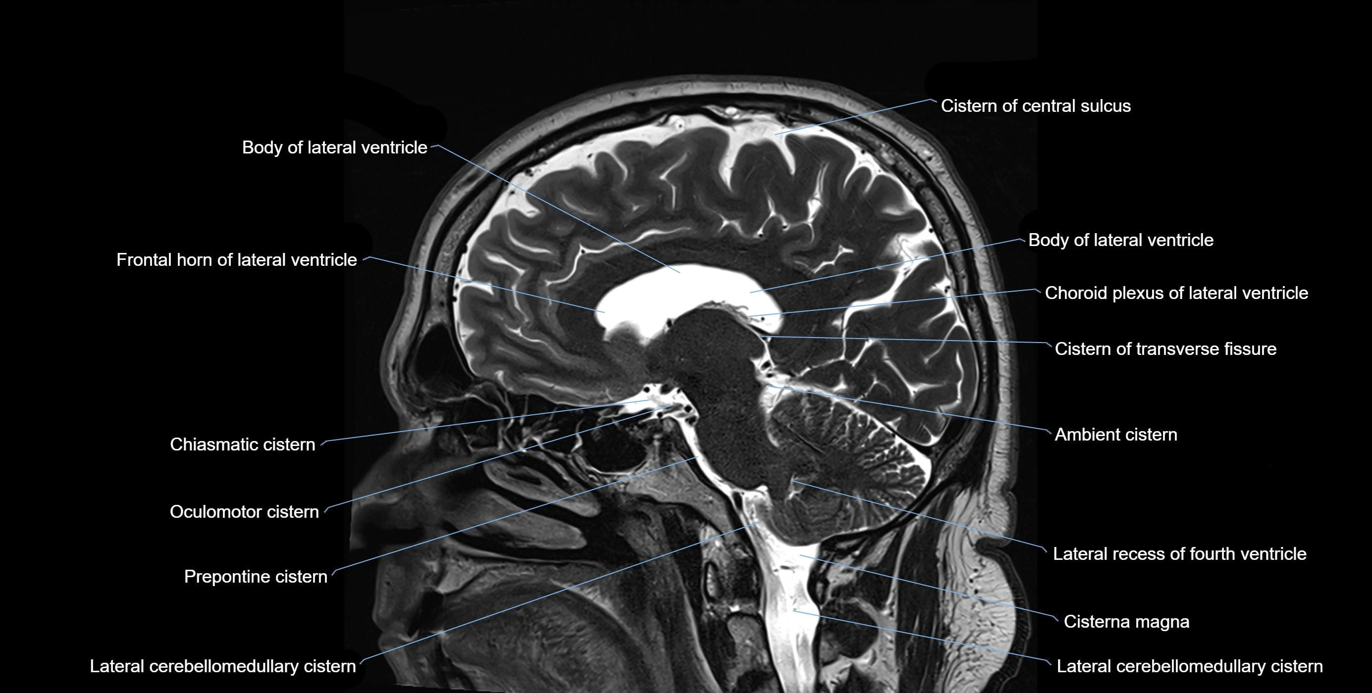 Brain cisterns  and ventricles sagittal anatomy 3T MRI image-img-00001-00025.webp